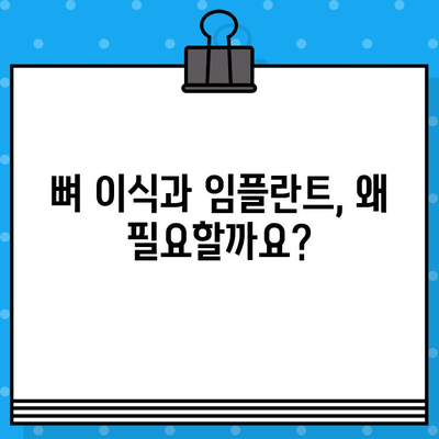 뼈 지주력 이식과 임플란트| 비용 고려 가이드 | 치과 수술, 가격, 견적, 정보, 상담